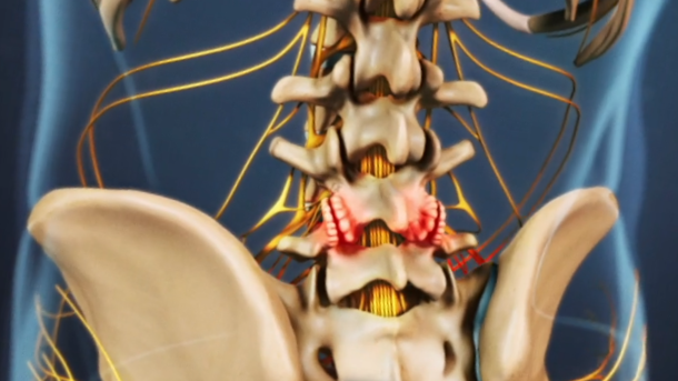 Hình Viêm khớp thoái hoá (viêm khớp mặt)